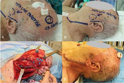 Current Surgical Therapy of Locally Advanced cSCC: From Patient Selection to Microsurgical Tissue Transplant. Review